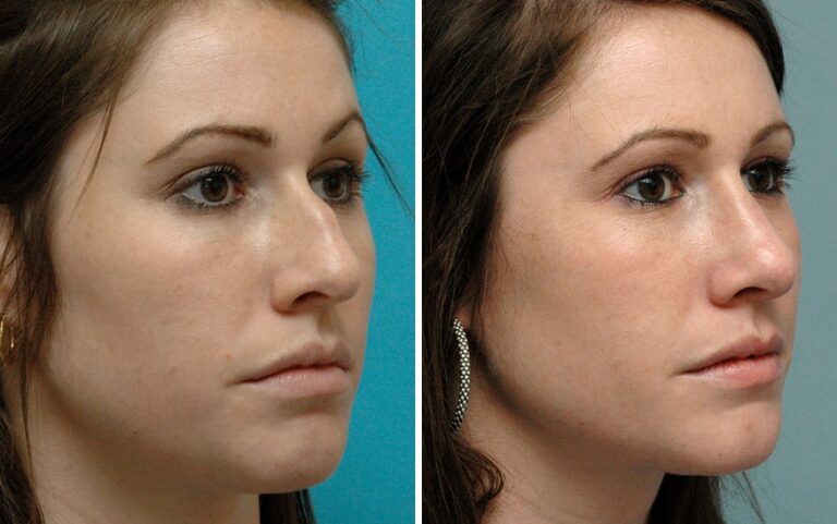 rhinoplasty