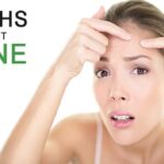 Myths About Acne's Best