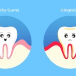 Gum Disease Affects