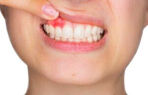 Treating Gum Diseasess