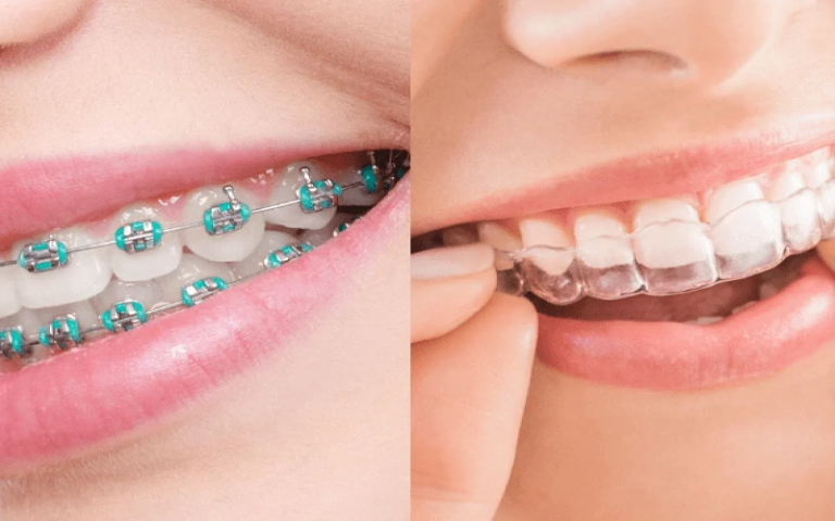 Traditional Braces