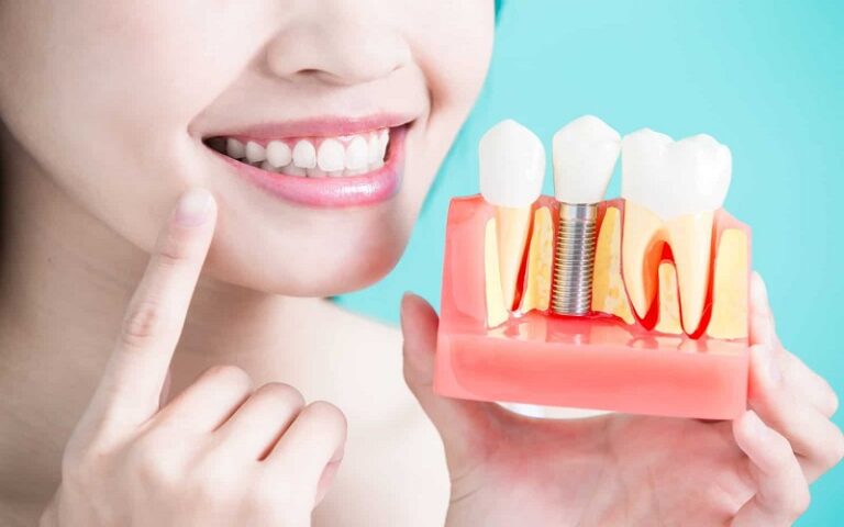 Understanding Dental Implants