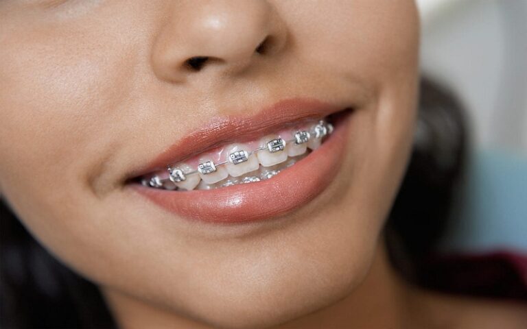 Orthodontic Retainers