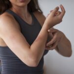 Itching Happens in Dengue