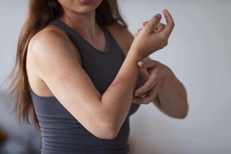 Itching Happens in Dengue