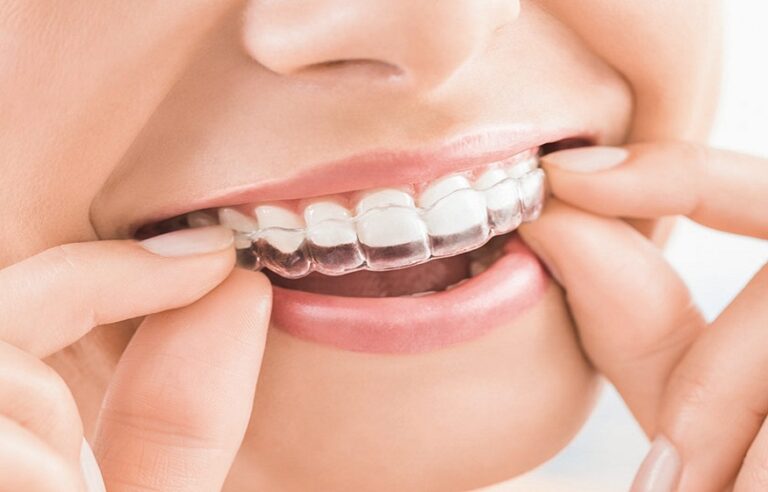 Boulder cosmetic dentist